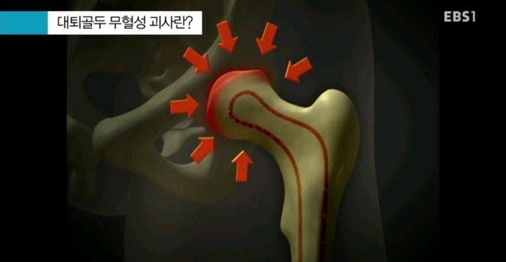 무서운 스테로이드 부작용.jpg | 인스티즈